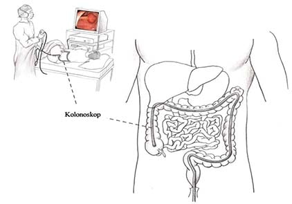 Kolon Kanseri Muayenesinde Kolonoskop Kullanılarak Poliplerin Çıkarılması