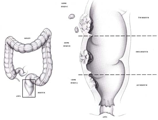 Rektum Kanserinin Bağırsaktaki Dağılımı