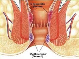 Dış (Eksternal) Hemoroid Anal Kanal ve Hemoroidal Damarlar